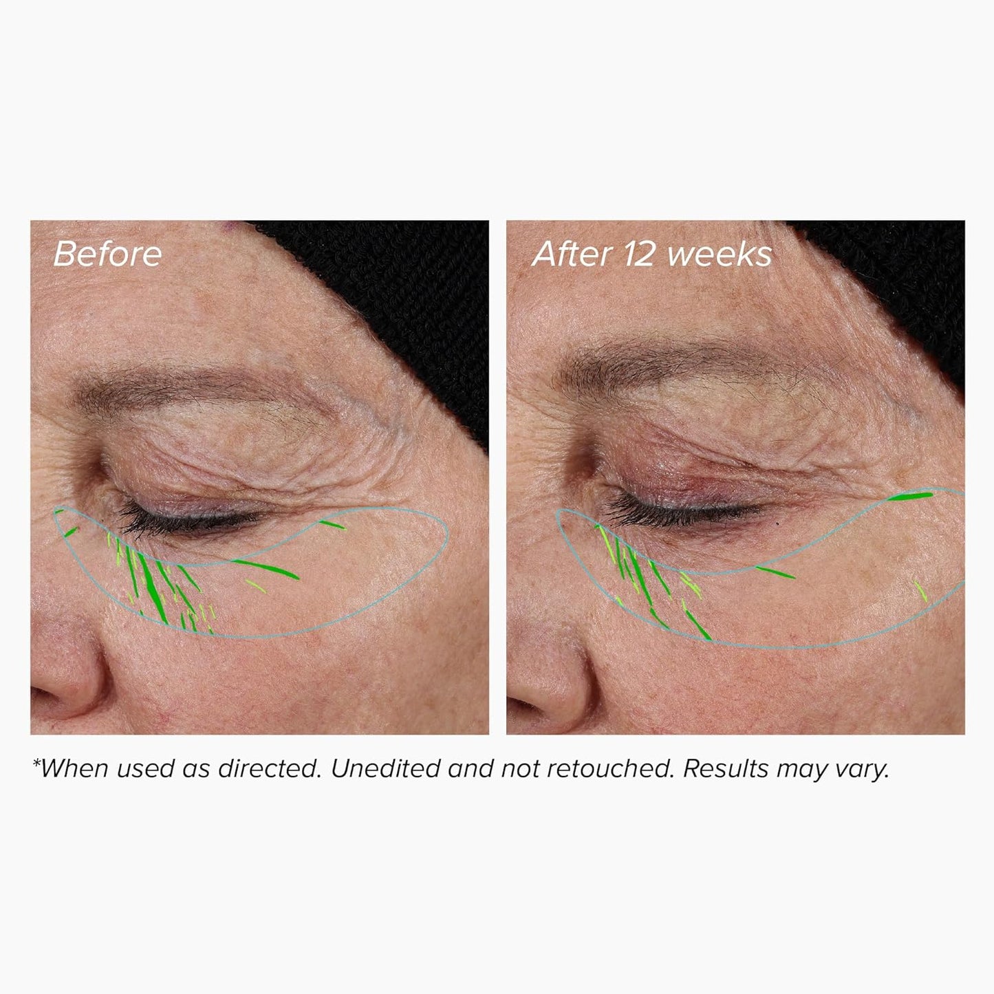 🏆Flash Sale⚡ 50K+ SOLD! Almost Gone-🔥Needle-less Growth Factor Serum